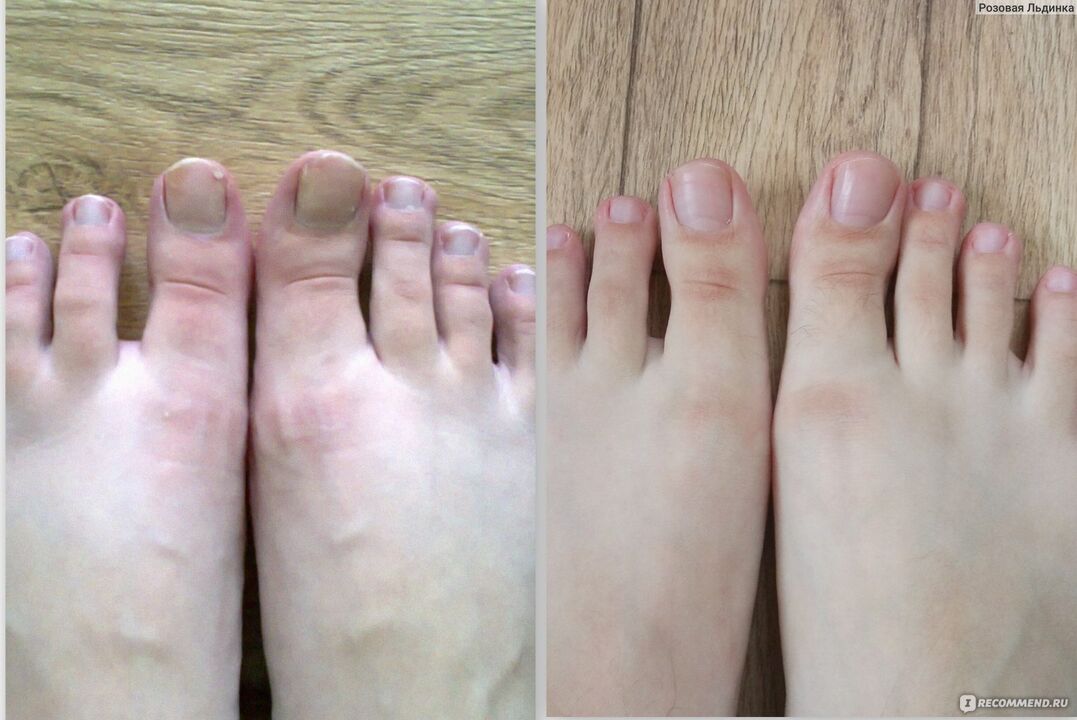 Before and after treatment of fungus with Fungostop Plus cream