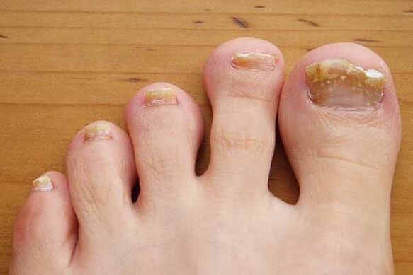 The appearance of toenails is affected by fungus