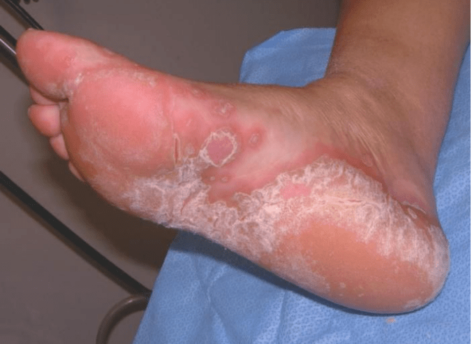Confirm the foot fungus