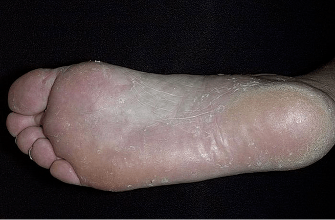 Foot fungus