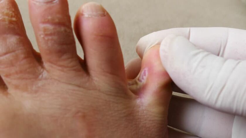 Fungus between fingers