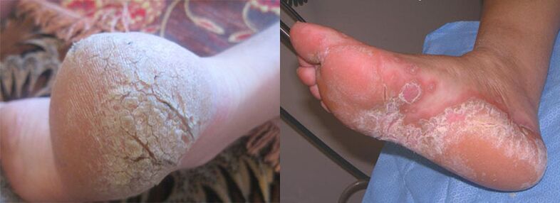 Fungus-affected feet