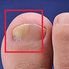 Mycotic diseases or nail fungi