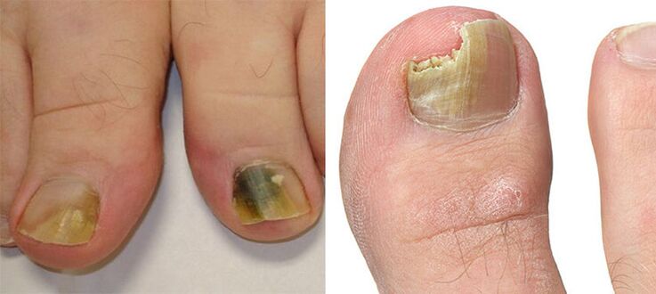 Onychomycosis - Fungus destroys nails