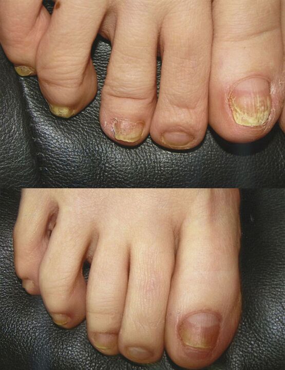 Treatment of fungi using boric acid