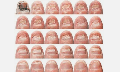 What is nail fungus like