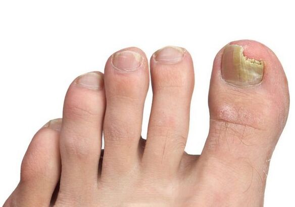 How to get fungal infection