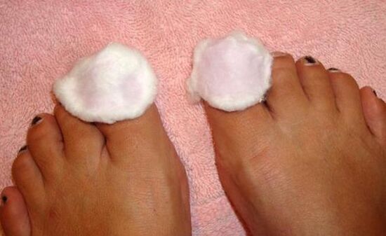 Compression Treatment for Toenail Fungus