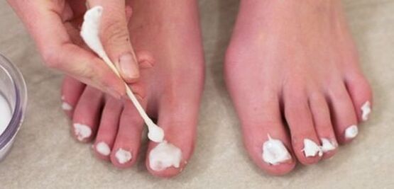 Treat toenail fungus with ointment
