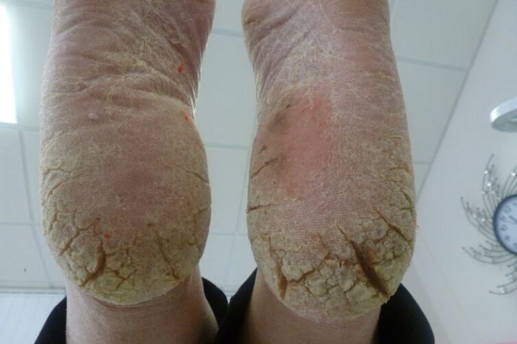 Deep cracks appear on the skin of the feet, and advanced fungi are present