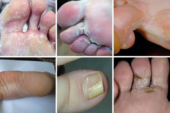 Sweating disorder form of foot fungus