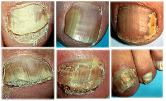 Types and forms of fungus on toenails