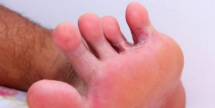 fungus between toes