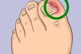 Ingrown toenails due to toenail fungus
