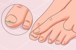 fungal nail infection
