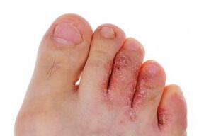 toe fungal infection
