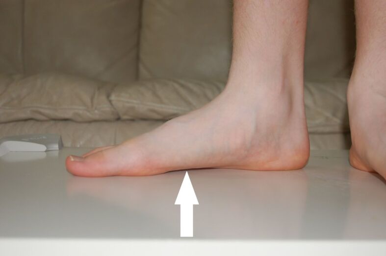 Causes of flat feet