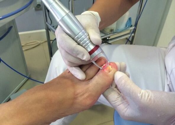 Laser treatment of big toe onychomycosis