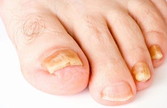 Onychomycosis Malnutrition (Advanced) Stage