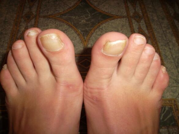 big toenail fungal infection