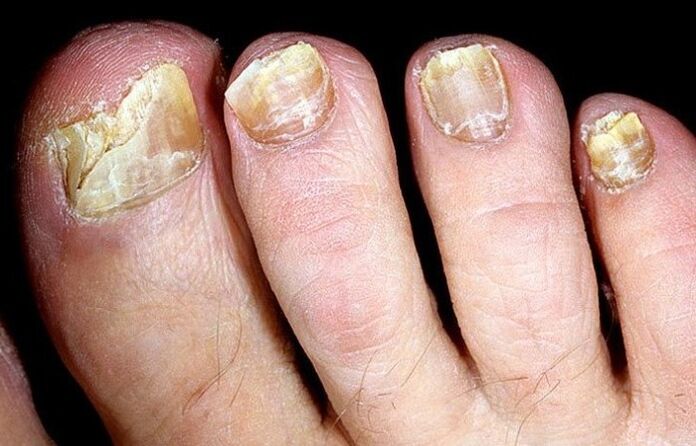 Advanced toenail fungus requiring complex treatment