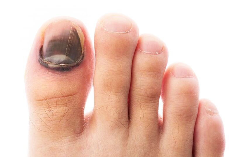 Toe nail plate fungal infection